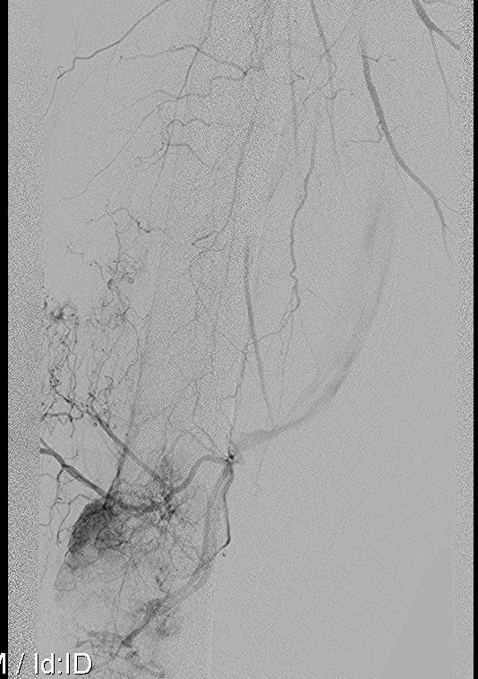 Renal Met Embolisation